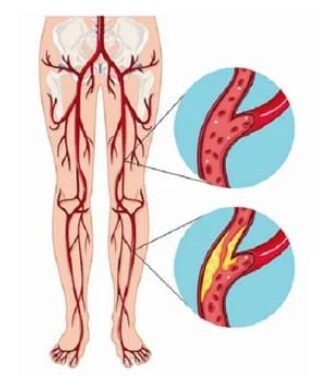 Ilustración médica de insuficiencia arterial en las piernas